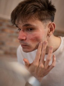 barriera cutanea danneggiata uomo con pelle faccia arrossata